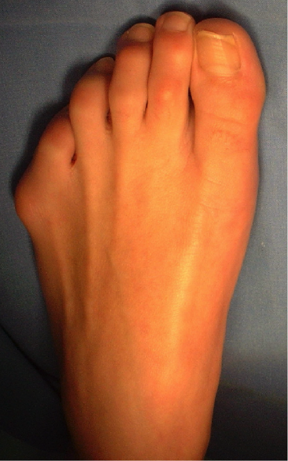 Clinique Du Pied Podo Clinique Hallux Valgus